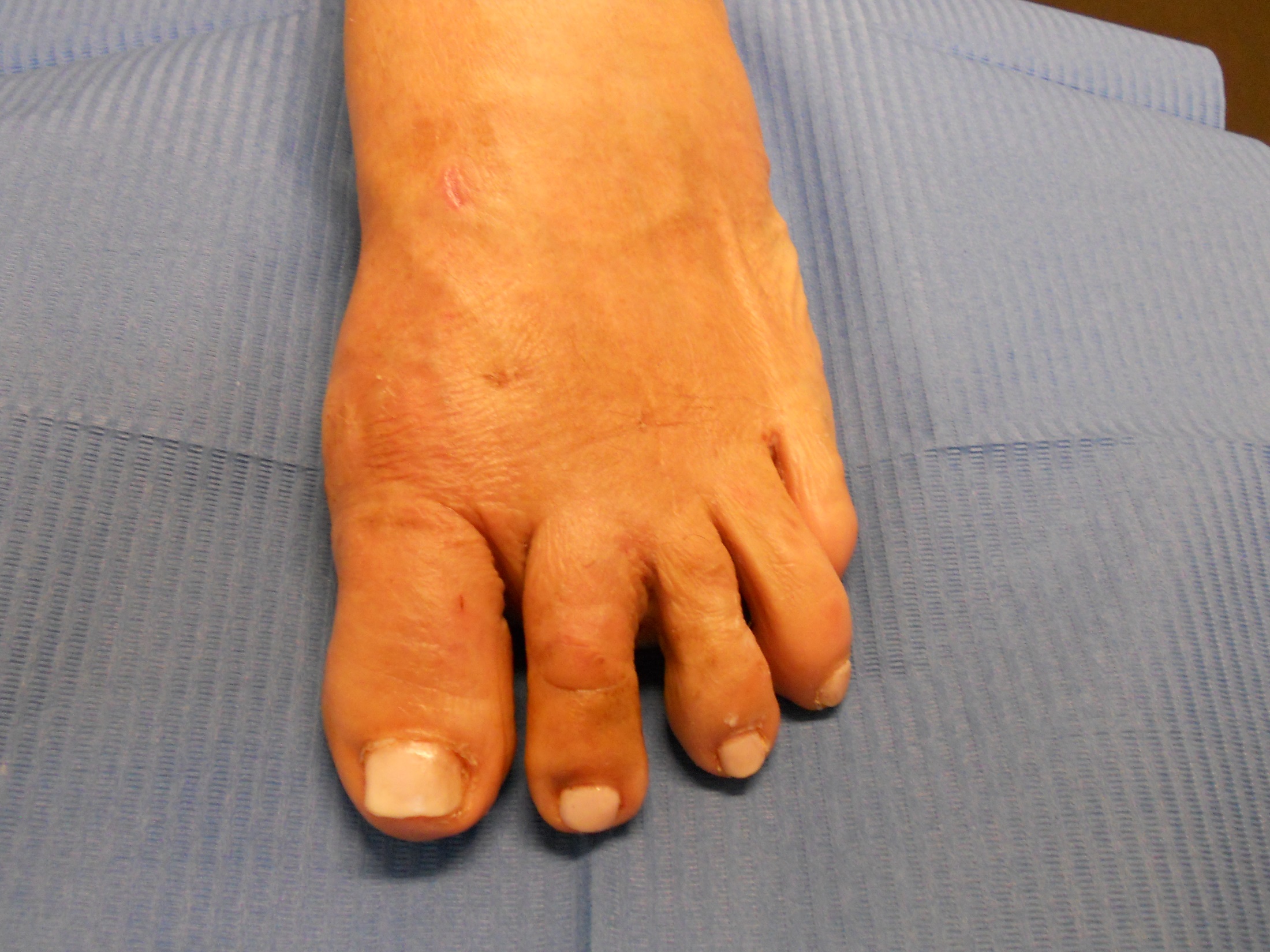 Hallux valgus: después